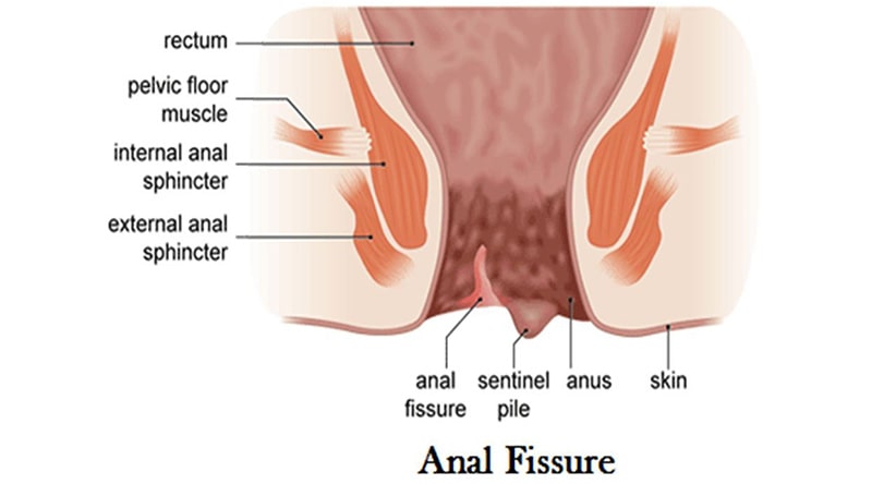 Anal Fistula