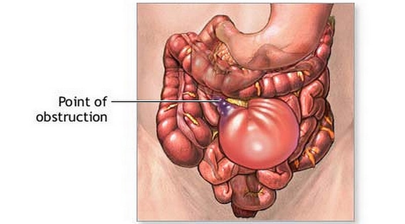 Bowel Obstruction Surgery - Dr Mikhail Mastakov