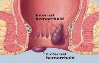 Haemorrhoidal Artery Litigation