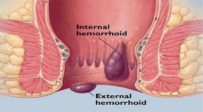 Haemorrhoidal Artery Ligation