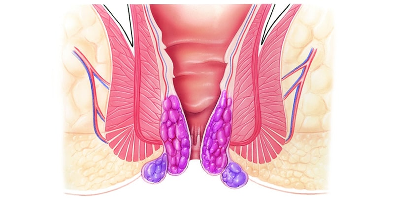 Haemorrhoidectomy