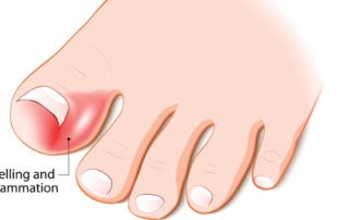ingrown toenail surgery Brisbane