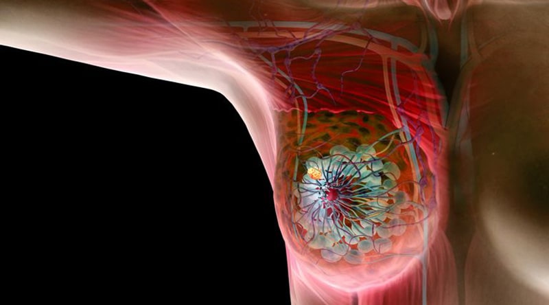 Malignant Breast Conditions