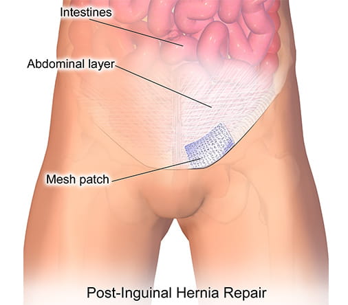 inguinal hernia