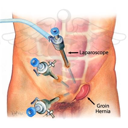 laparoscpic hernia repair