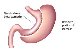sleeve-gastrectomy