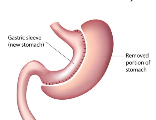 Gastric Sleeve Procedure: What You Need to Know : Brisbane Clinic