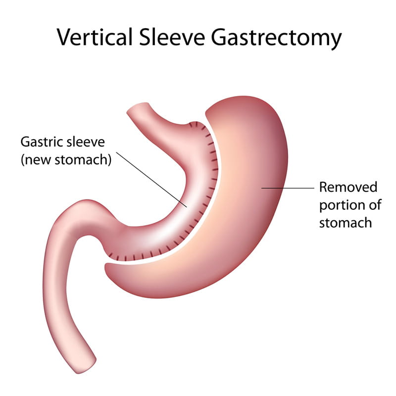 sleeve gastrectomy