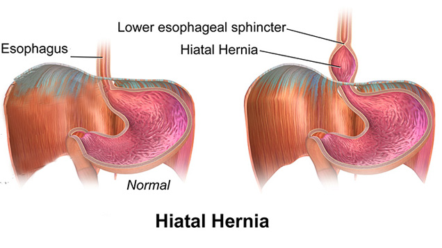 Hiatal Hernia Repair