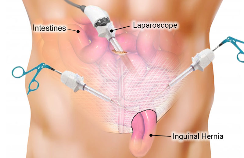 Minimally Invasive Surgery of the Groin: Inguinal Hernia Repair