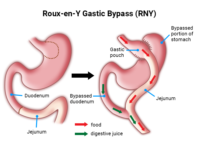 sleeve gastrectomy