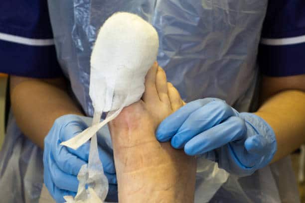 Ingrown Toenail Surgery Brisbane 2 Ingrown Toenail Surgery