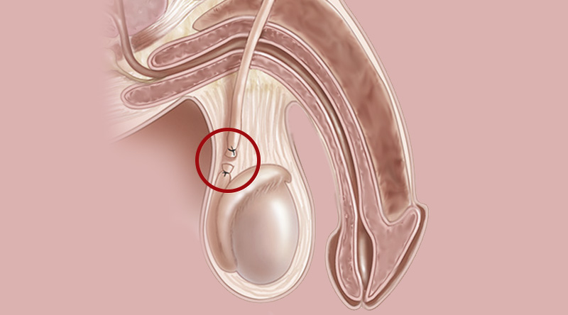 Hydrocele and Varicocele - Dr Mikhail Mastakov